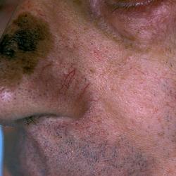 Example of skinCancerAndMelanomas